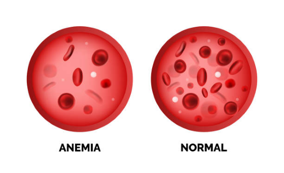 Takto nejako si môžeme predstaviť počet červených krviniek pri anémii (vlvevo) alebo v prípade, že je dotyčný zdravý (vpravo)